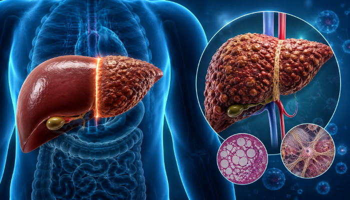Cirrhosis & Chronic Liver Disease (CLD): Causes, Symptoms, Stages & Management