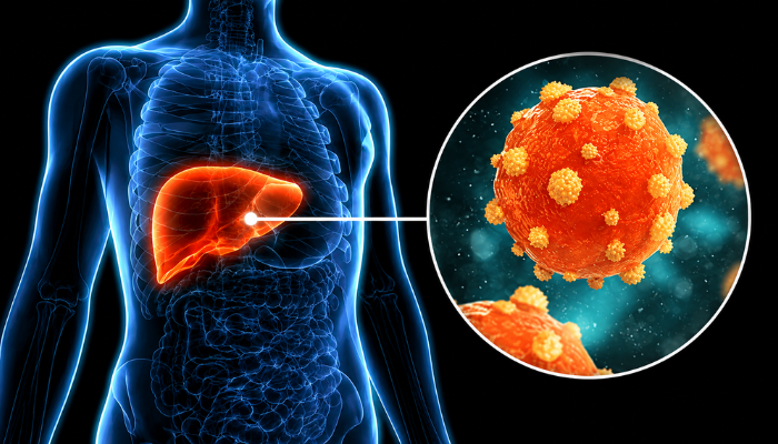 Hepatitis C: Symptoms, Causes, Diagnosis & Treatment