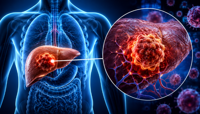 Liver Cancer: Causes, Symptoms, Diagnosis & Treatment